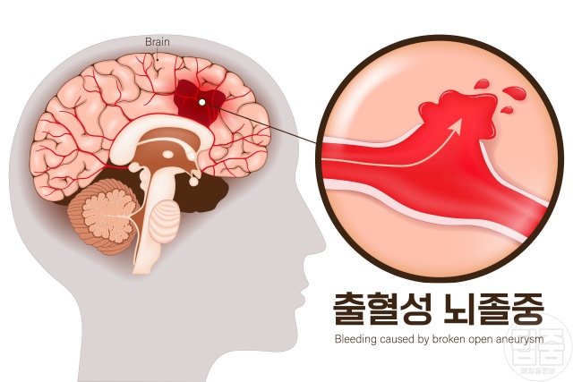 뇌졸중 환자 공통점 고혈압