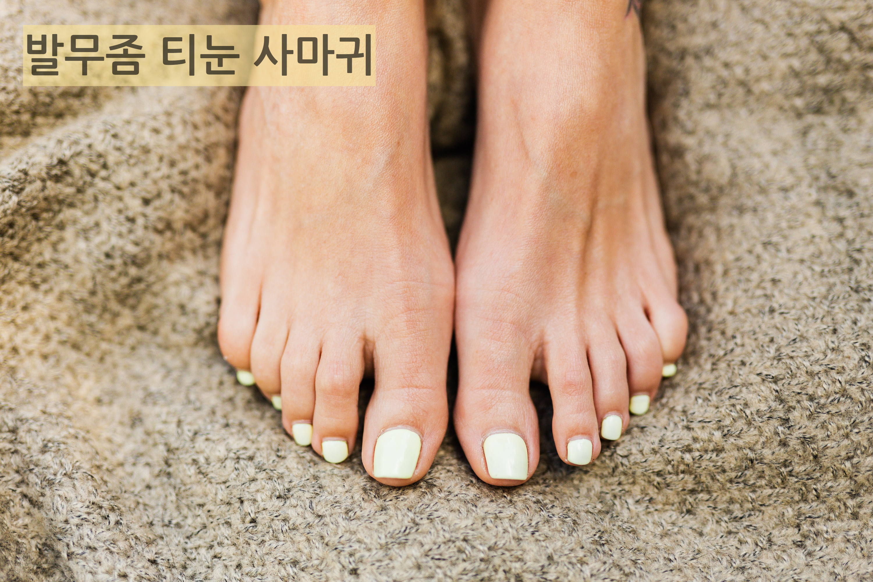 무좀