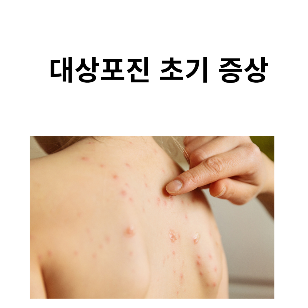 대상포진 초기증상