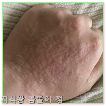 손등 좁쌀 두드러기 피부장벽 회복과 보습 꿀팁2