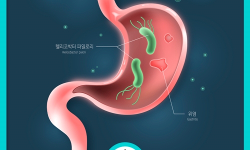위암 이미지