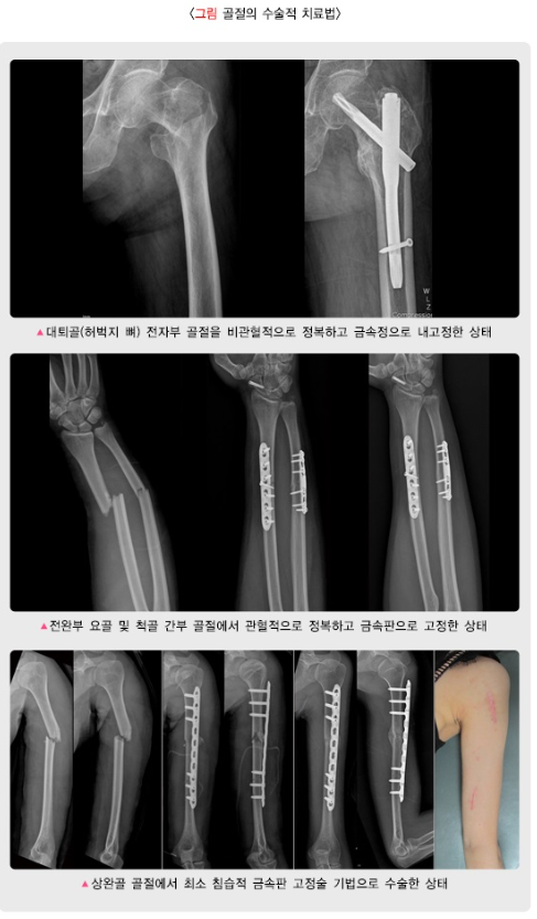 골절의 수술적 치료