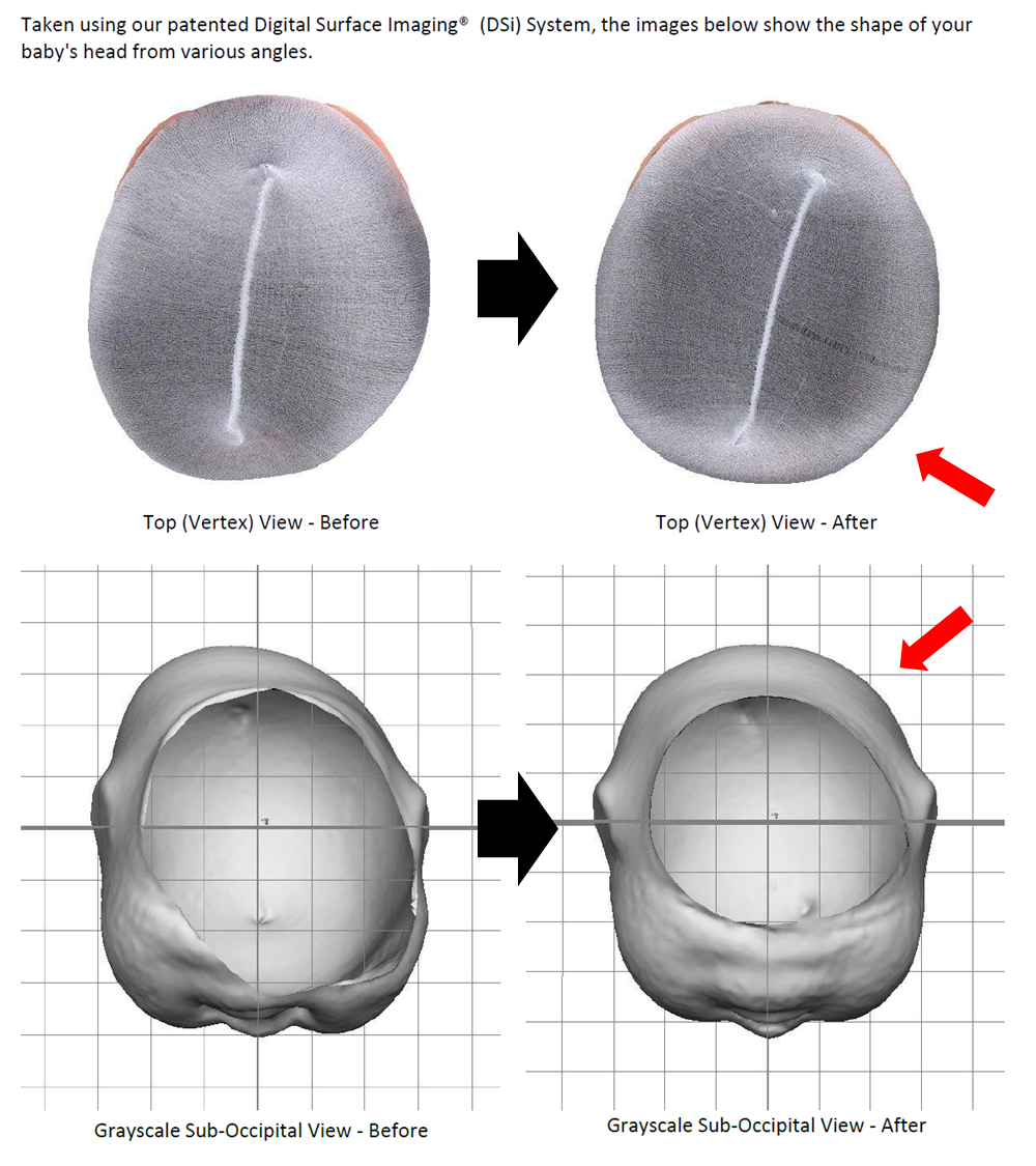 두상 헬맷 교정