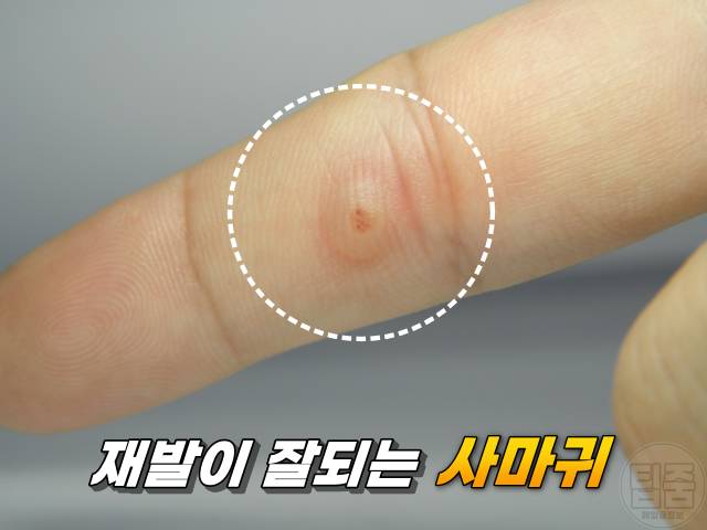 사마귀예방 사마귀 제거 연고