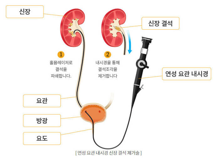 신장결석 제거술