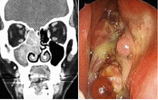 부비동암-비강암-증상-원인-진단-(+비염과-차이점-)