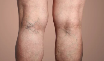 하지 정맥류 증상