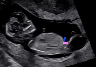 태아성별확인 관련한 각도법 초음파사진