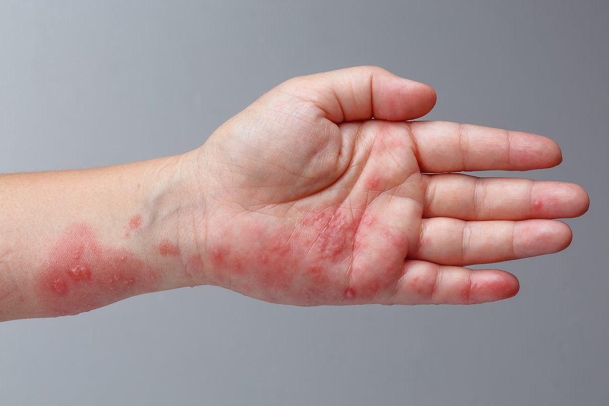 Appears on shingles hand