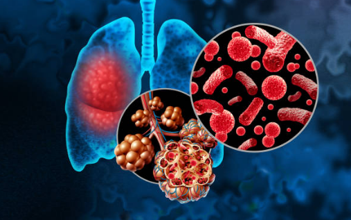 폐렴 증상, 전염성, 치료기간 총정리 (2024ver)