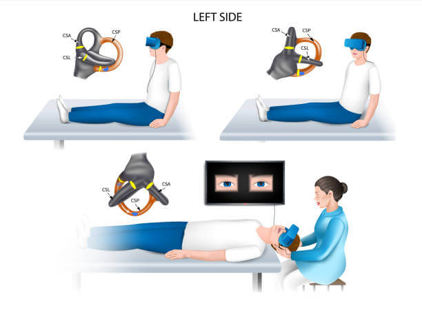 이석증 검사방법 총정리! 어지럼증 원인부터 정확한 진단까지