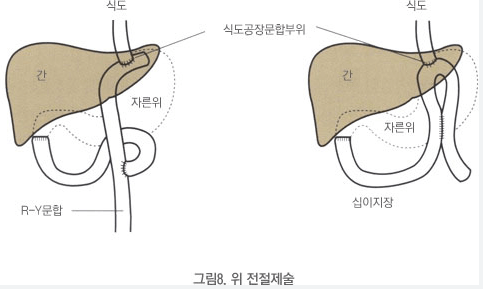 위암 증상