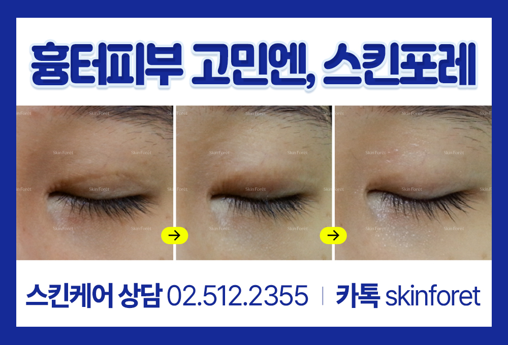 눈 흉살로 인한 안구건조증, 쌍꺼풀 흉터 관리