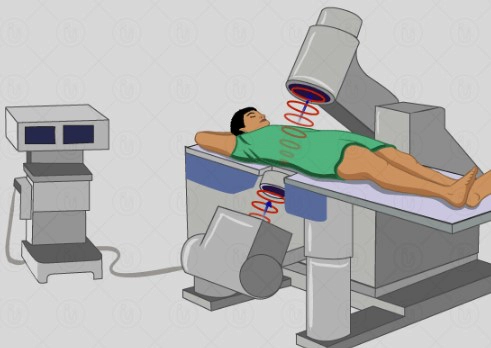 체외충격파쇄석술 과정 
