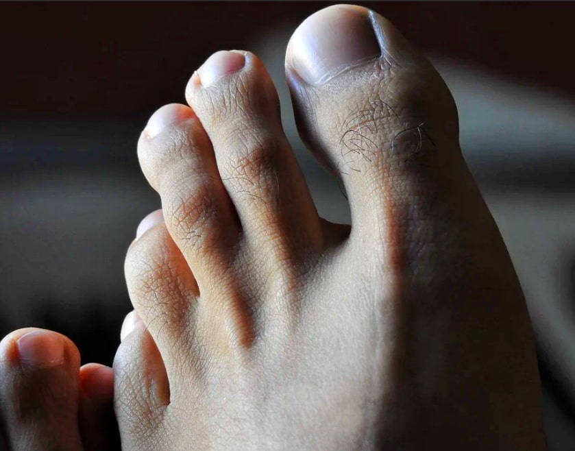 엄지발가락 저림 증상
