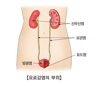 신우신염