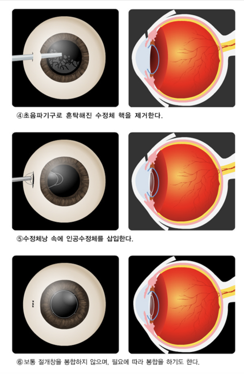 백내장 수술방법