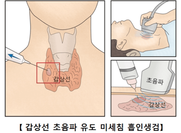 갑상선암