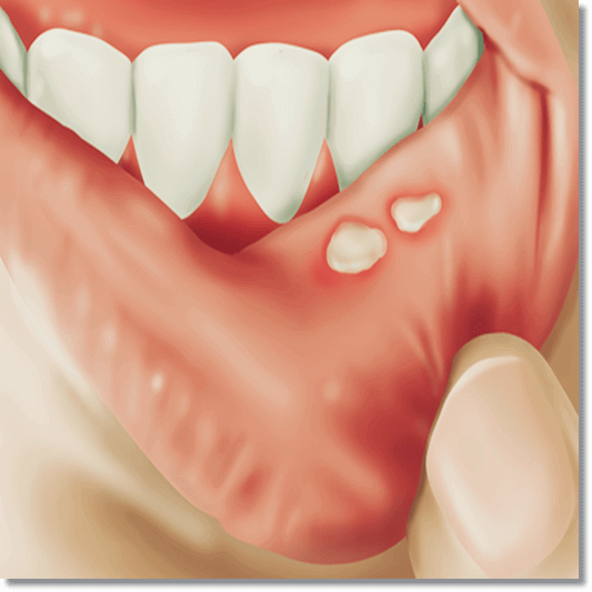 아프타성 구내염 증상, 원인 및 예방과 치료
