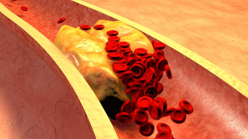 혈관속에 지방이 막혀있는 이미지