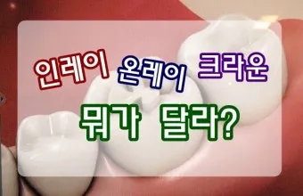 인레이 온레이의 차이와 치료 방법_17