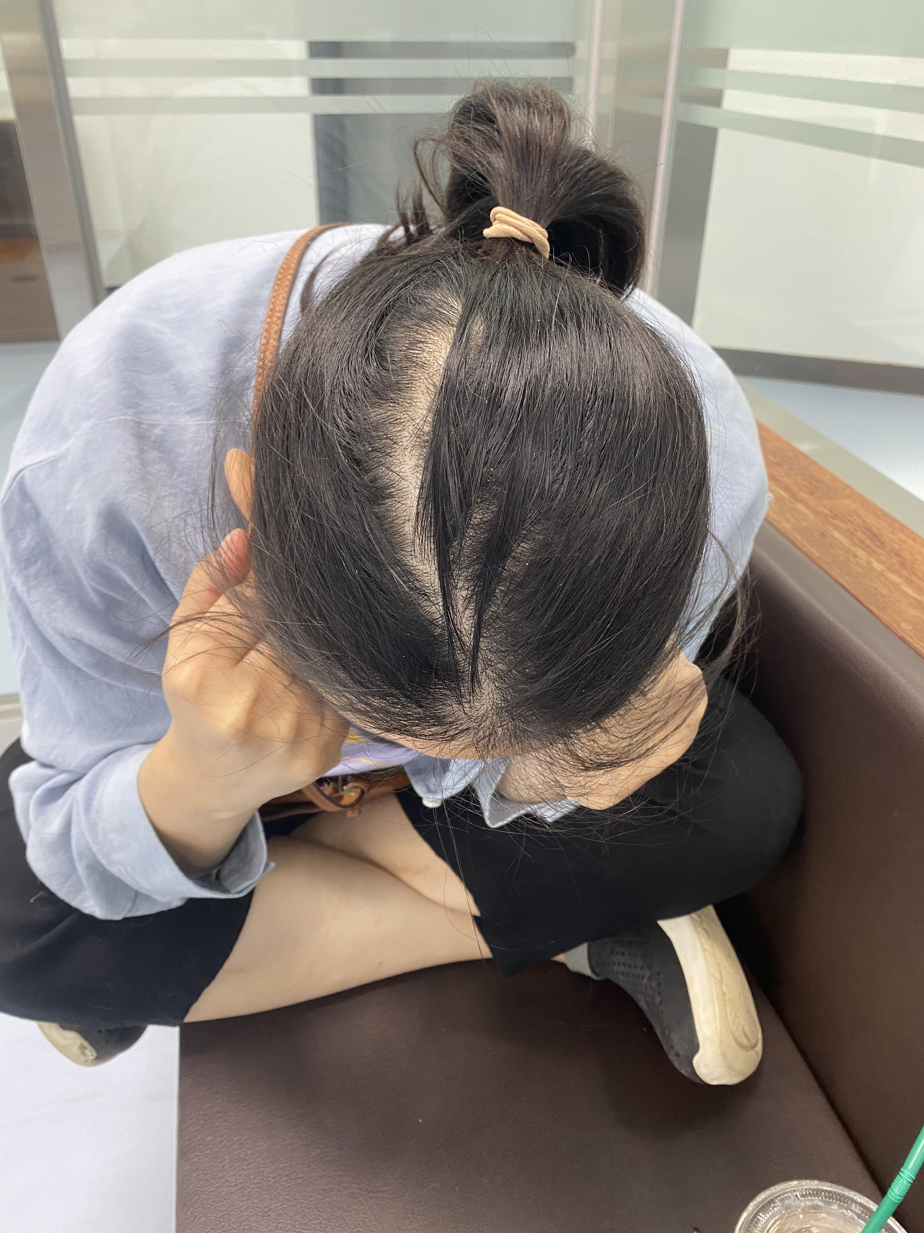 탈모..극혐