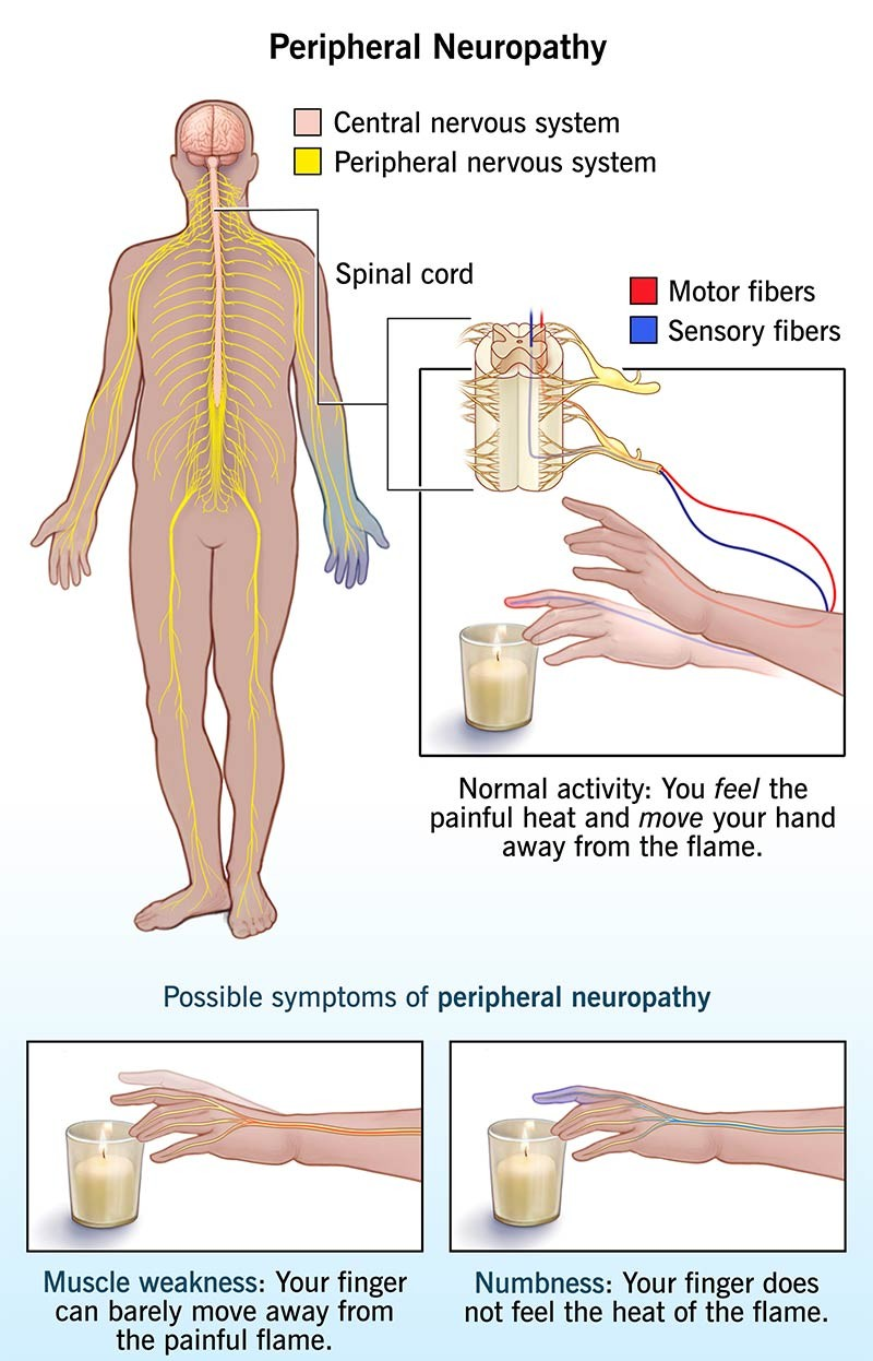 말초신경병증약