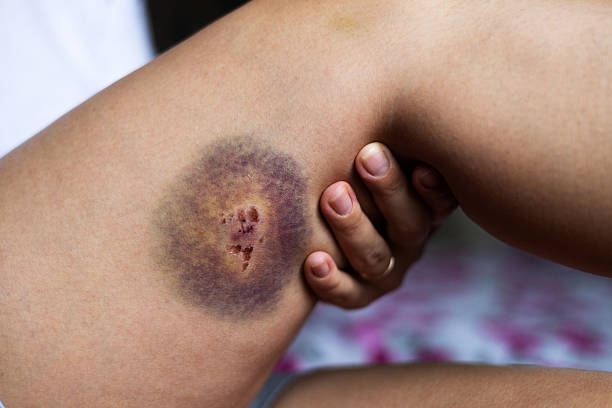 폴댄스 멍이 생기는 이유와 관리 방법