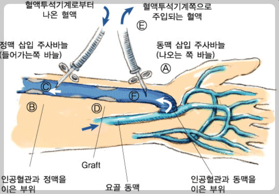 신장투석 생존기간