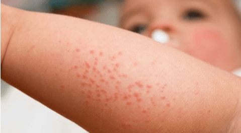 아기 땀띠 관련 사진