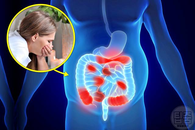 배가 찌르듯이 아픔 게실염 증상 메스꺼움 구토