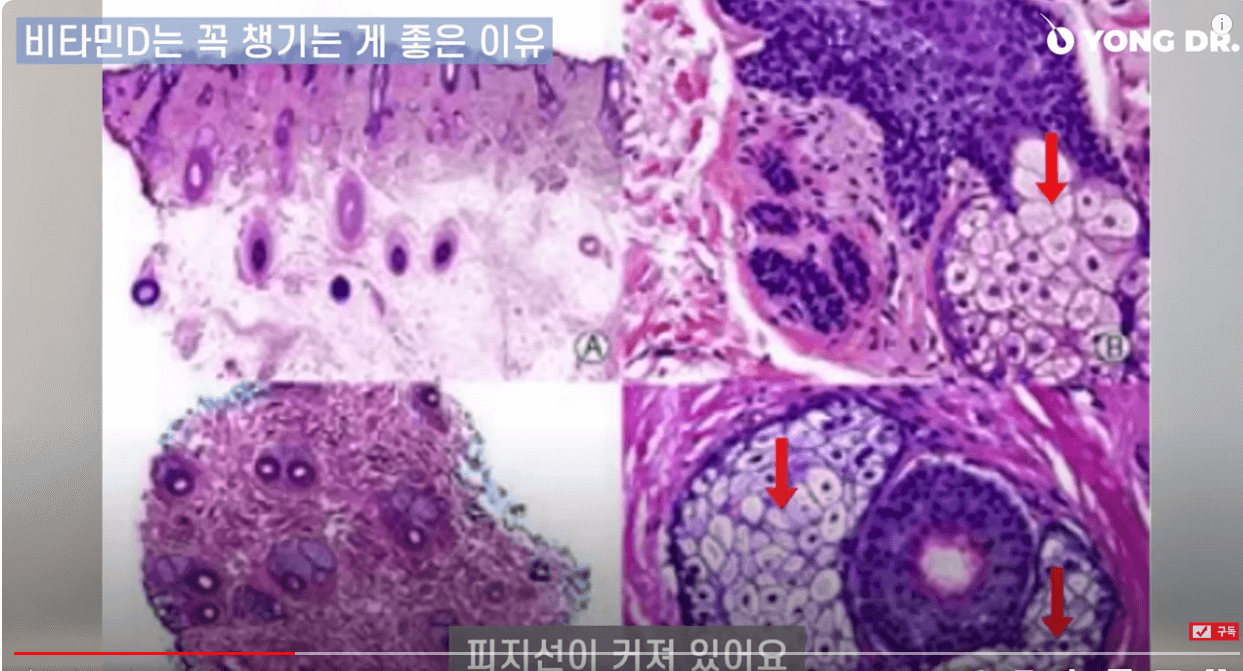 탈모에 