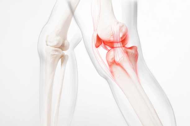 관절염 초기 증상