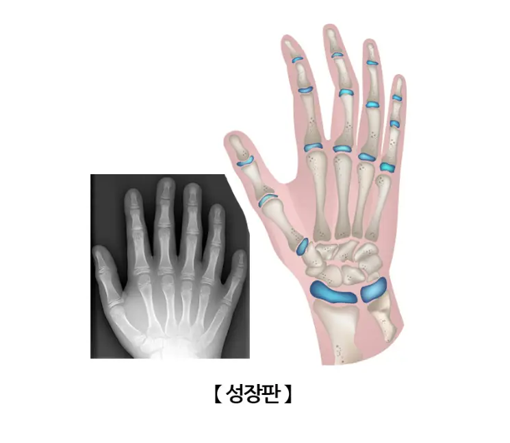 손-성장판-모양