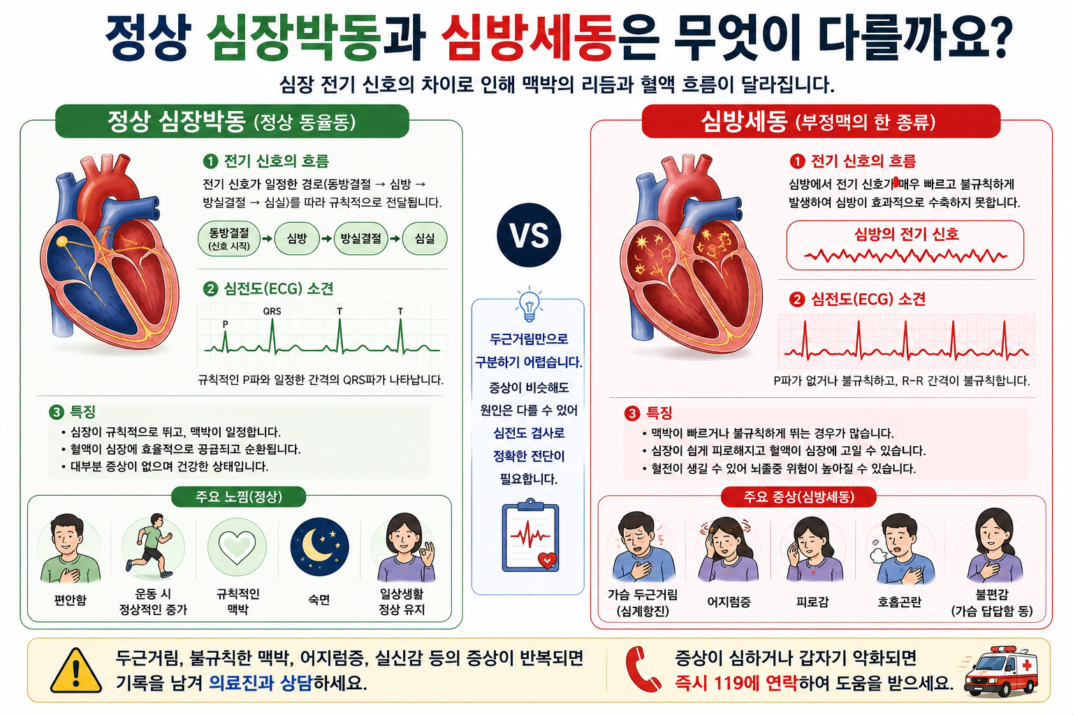 정상 동율동과 심방세동의 차이를 설명한 개념 그림으로 진단용 심전도는 아님