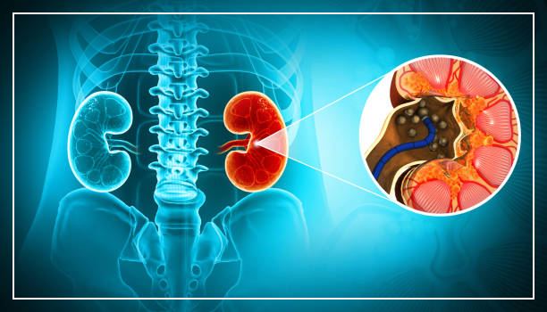 허리통증이 요로결석(Urolithiasis) 원인?