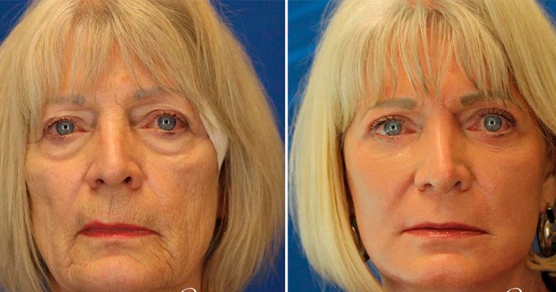 안면 거상 전후