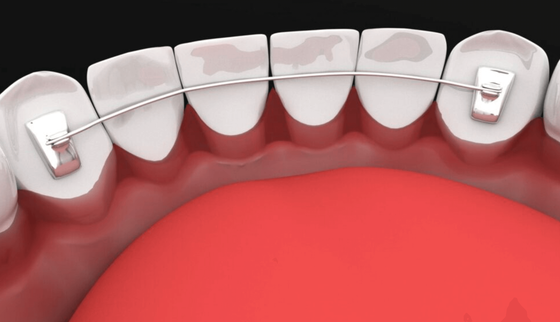교정기 가격 비용