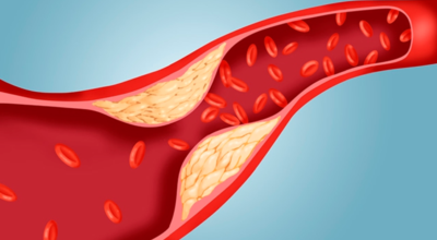 콜레스테롤 이미지