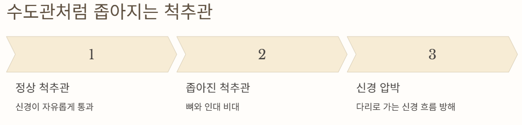 좁아지는 척추관