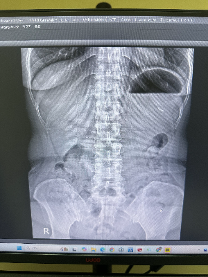 병원 모니터에 띄워진 요추 X-ray 정면(AP) 영상