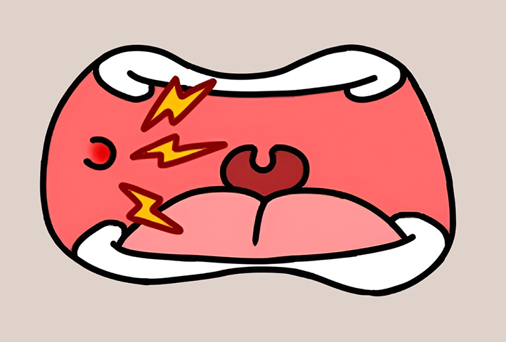 입안-물집으로-고통그러운-모습