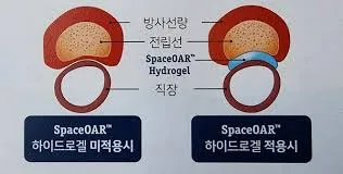 전립선암 초기증상