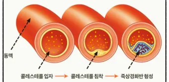 LDL 콜레스테롤 정상수치 낮추는법_4