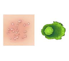 대상포진 초기증상