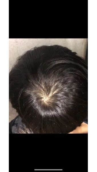 정수리가 아픈 이유와 완화하는 방법_5