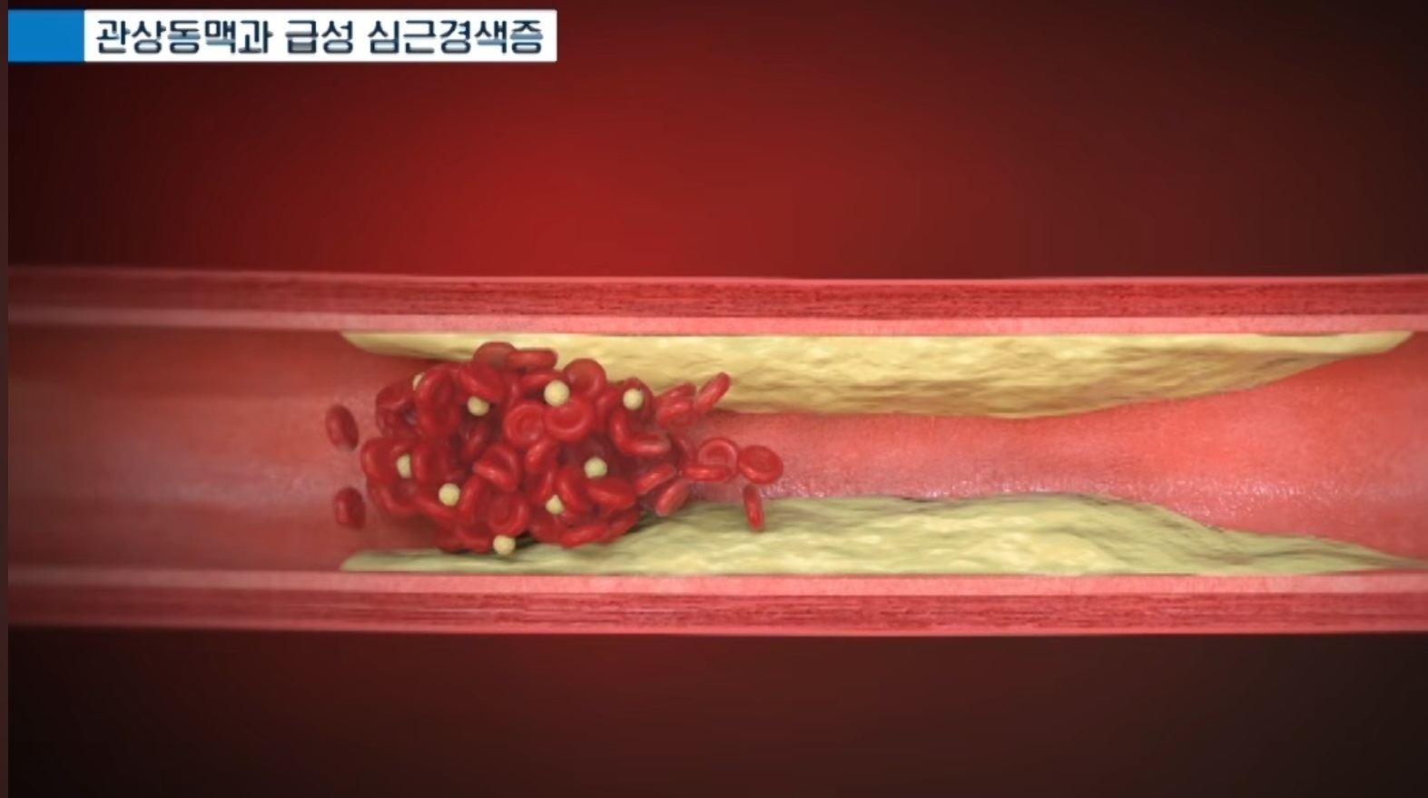 EBS명의-급성-심근경색