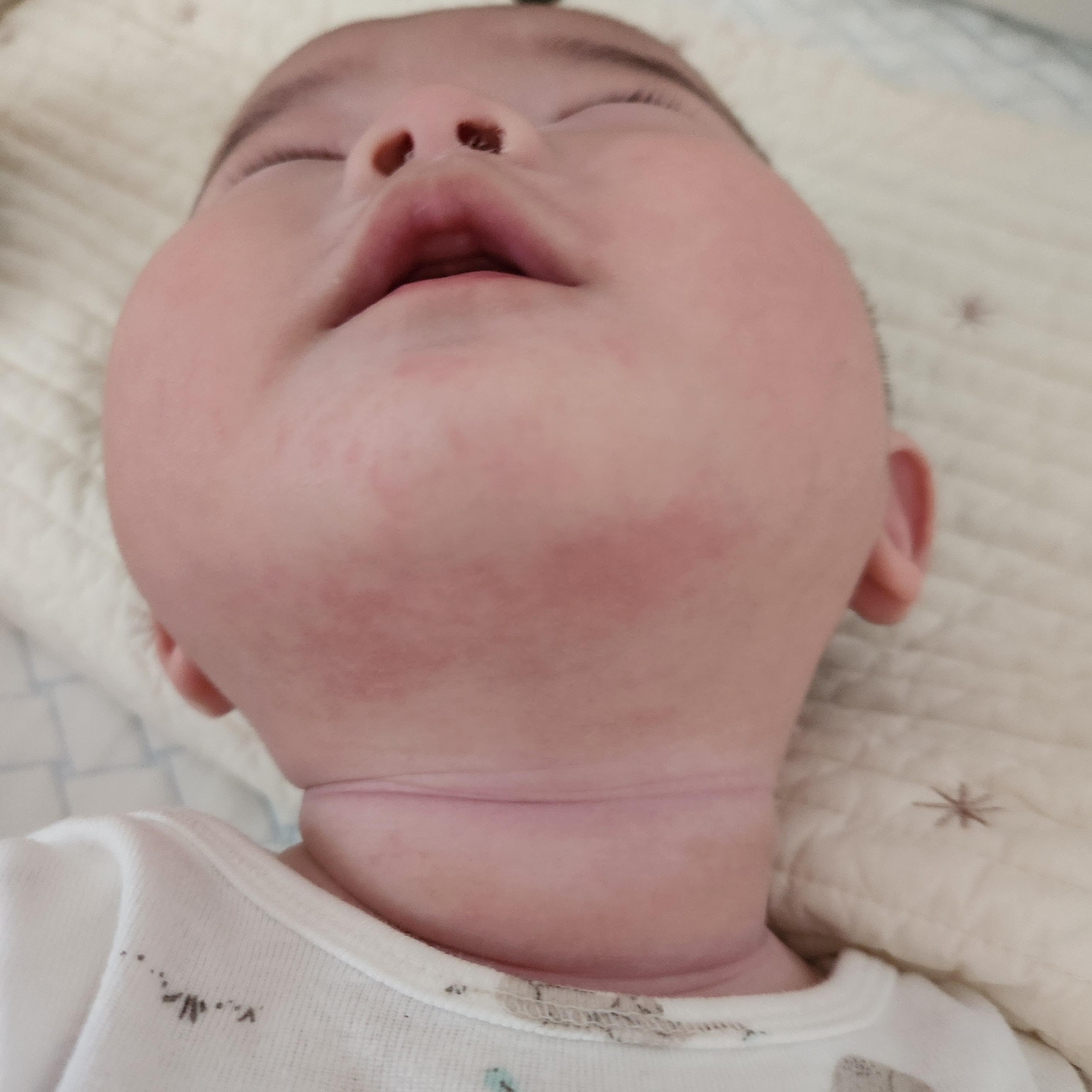 이유식두드러기