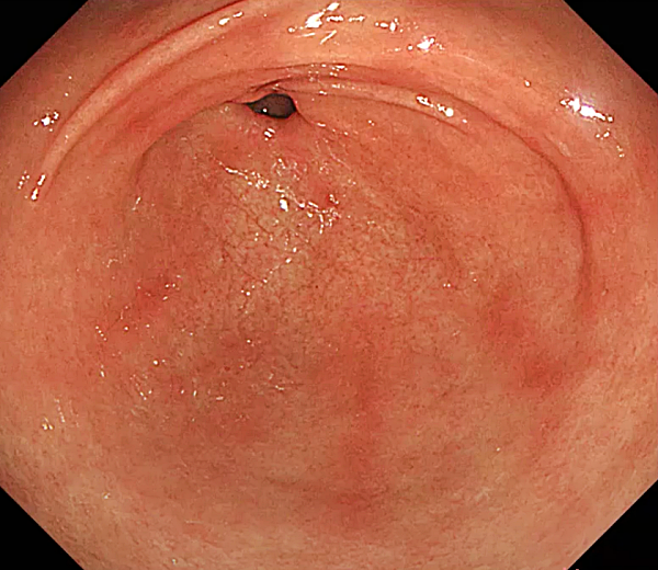 표재성 위염2_출처:속편한TV