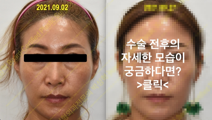눈밑지방재배치